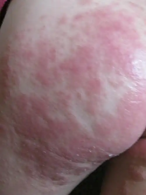 宝宝屁屁亮红灯原来是尿布疹惹的祸