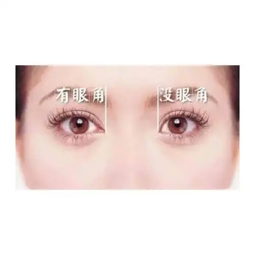 双眼皮手术你到底需不需要开眼角?
