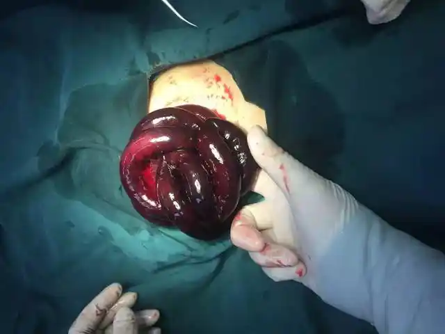 2岁宝宝腹痛呕吐不止医生剖开他的肚子60厘米长的肠子全黑了