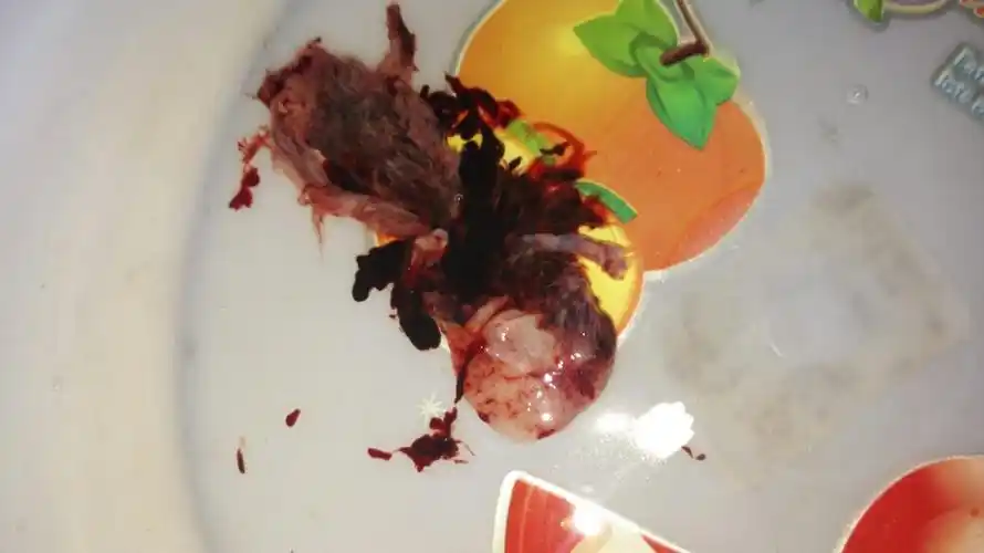 服用米索前列醇片七小时后排出物,请问这是孕囊么