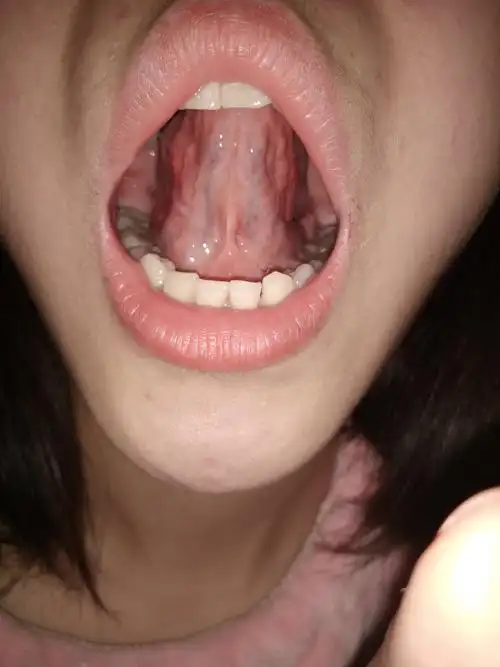 舌下络脉清楚 颜色略浅