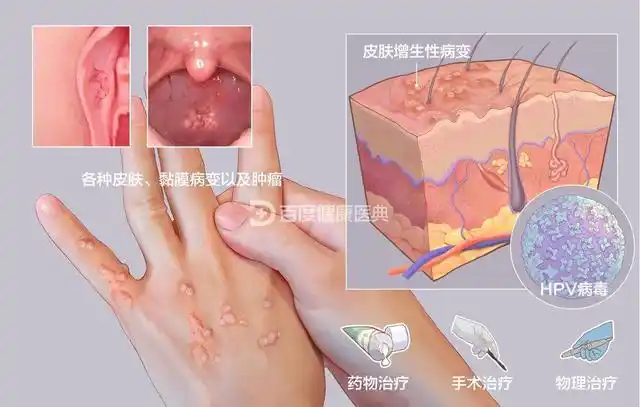 hpv(人乳头瘤病毒)你了解吗?