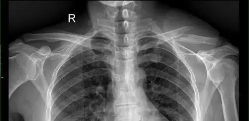 左锁骨骨折的治疗