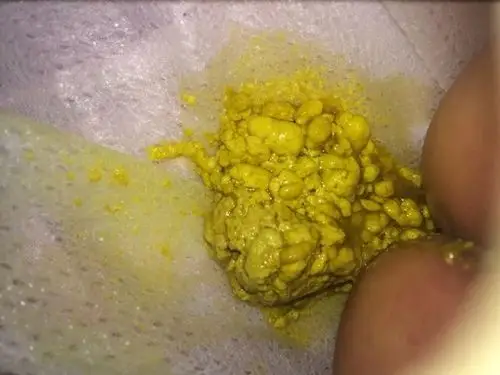 粪质少,如果宝宝精神状态也不佳,就表示宝宝可能得了病毒性肠炎,需要