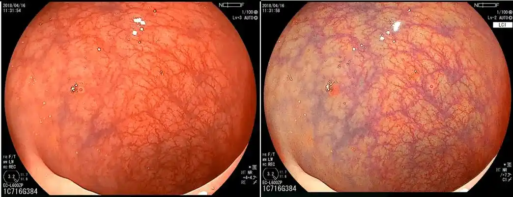 山本博德:早期胃癌的诊断与内镜下治疗