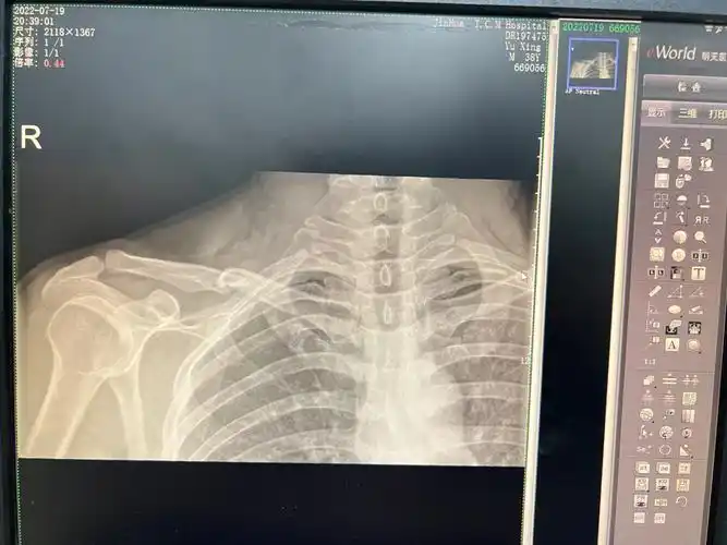 锁骨骨折多久可以骑车?分享一下我的经历!