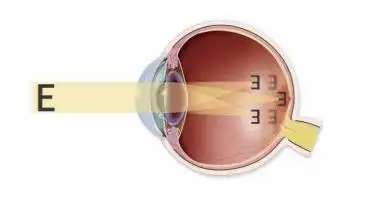 散光指的是眼球的不同经线,甚至在同一经线上具有不同屈光力的一种