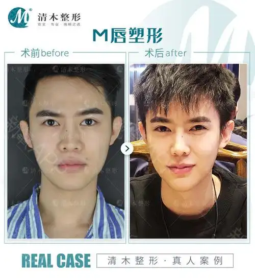 太薄的嘴唇,总是会_圈子-新氧美容整形