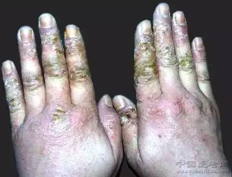 湿疹样皮炎162.左耳传染