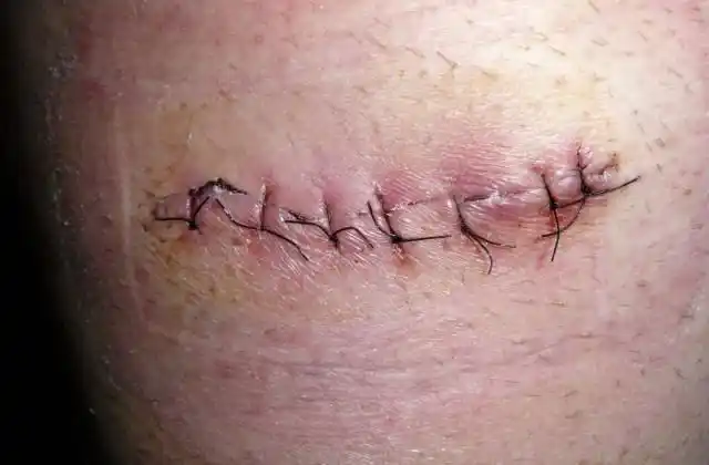 1.缝针的部位不要接触水,要保持伤口敷的纱布干燥.