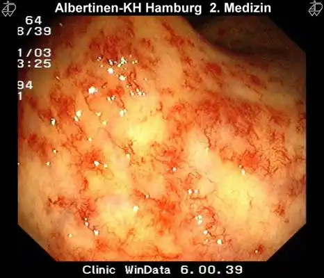肛癌早期症状图片 (11)_有来医生