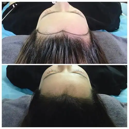 纹发际线操作前后对比