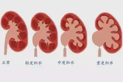 患者须知不痛的肾结石有时更可怕