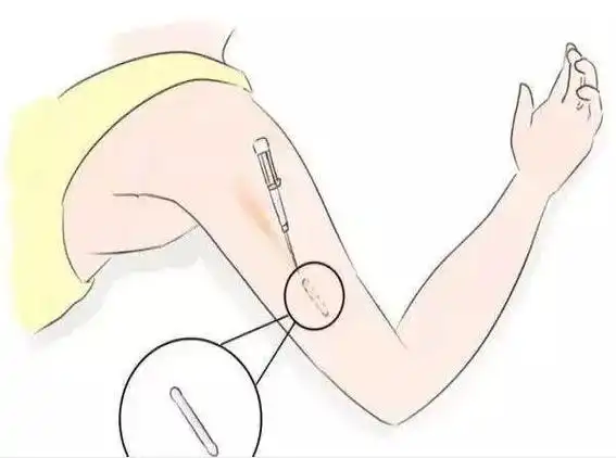 九江市妇幼保健院:期盼已久的皮埋避孕终于回来了