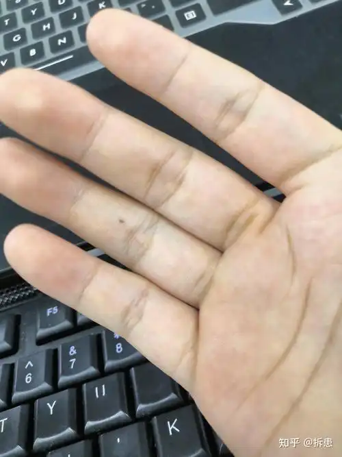 有没有手指上有痣的人