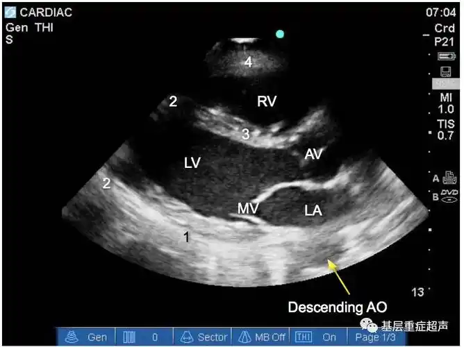 超声心动图切面介绍胸骨旁长轴胸骨旁短轴心尖切面剑突下切面