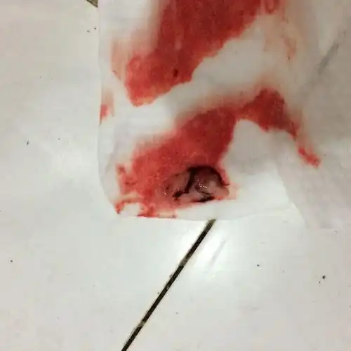 药流刮宫后刚刚出来这么一坨白色黏黏的东西 这是什么