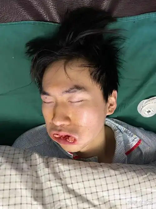 全麻拔智齿及术后恢复全过程