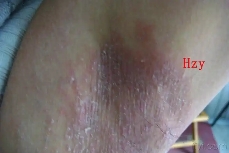 左腋下发痒疼痛三个月