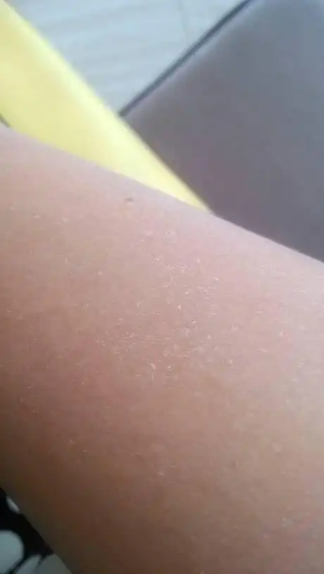 手臂上起了很多这样的小白点点像是脱皮了样!是什么症状