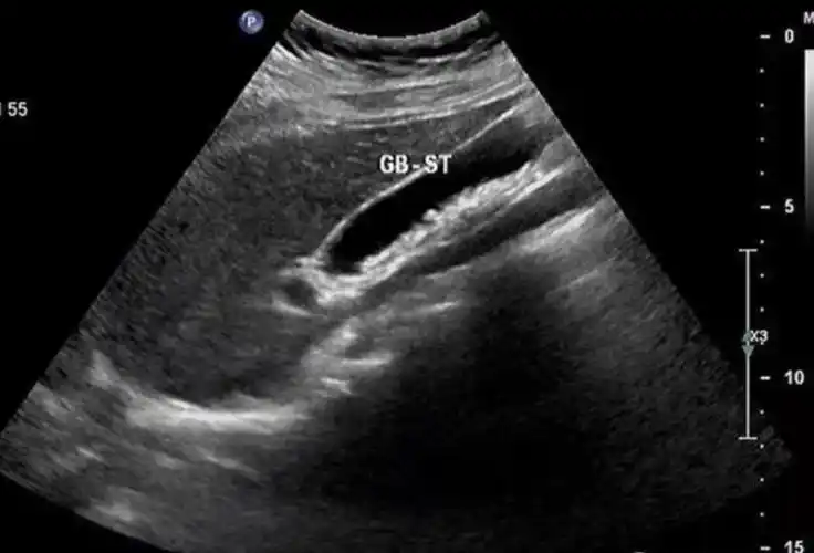 胆囊结石,超声这样表现