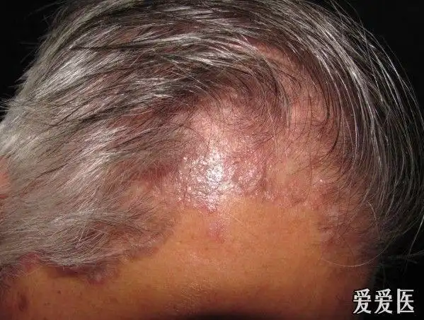 火眼金睛7答案银屑病头部发际表现