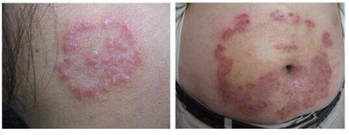 铜钱癣用什么药效果好,教你解决的正确方法