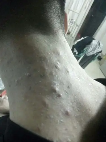 本人后背可能长了毛囊炎,有5年时间了,不知你们有什么方法去掉,快被