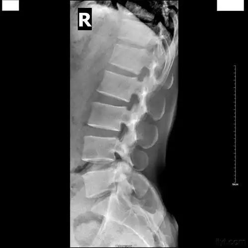 今天又有一例s1隐裂