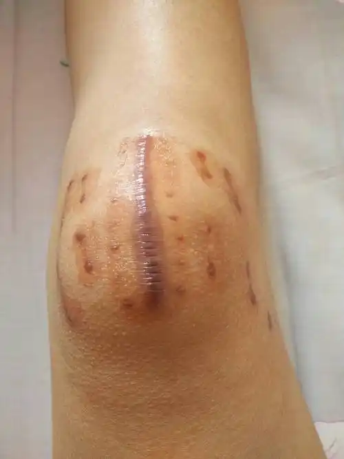 请问一下,我4月中旬做了膝盖滑囊炎手术,现在站的时间长了疤就会痒,13