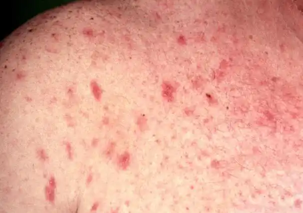 艾滋病初期_人工寻麻疹是艾滋病的初期症状吗_艾滋病感染一般初期会有