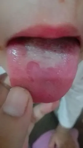 孩子舌头上总有一块块红的,怎么回事