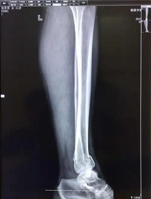 孙培权医师杏林妙手成功使下腿双骨折错位患者康复