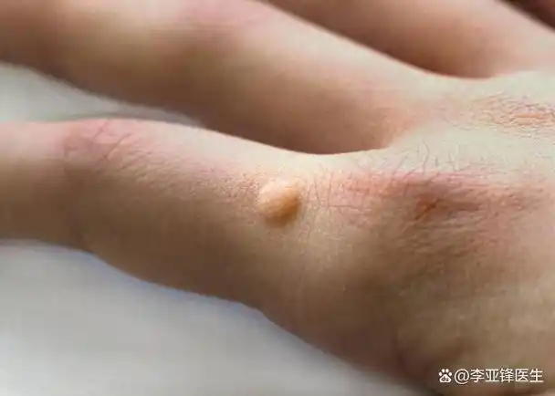 脸上,手上长了扁平疣,会不会传染给别人?医生教你快速消灭