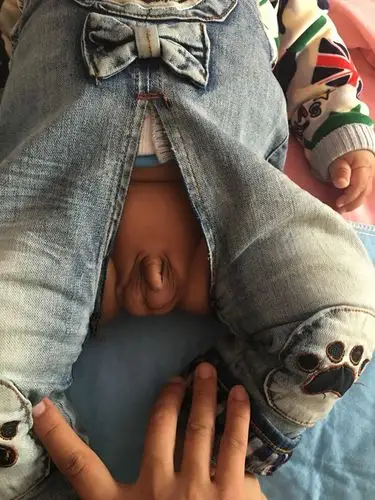 这是小儿疝气吗?_百度宝宝知道