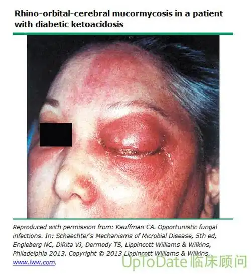 高能慎点印度多个邦爆发新冠康复者感染毛霉菌病例继黑色霉菌和白色