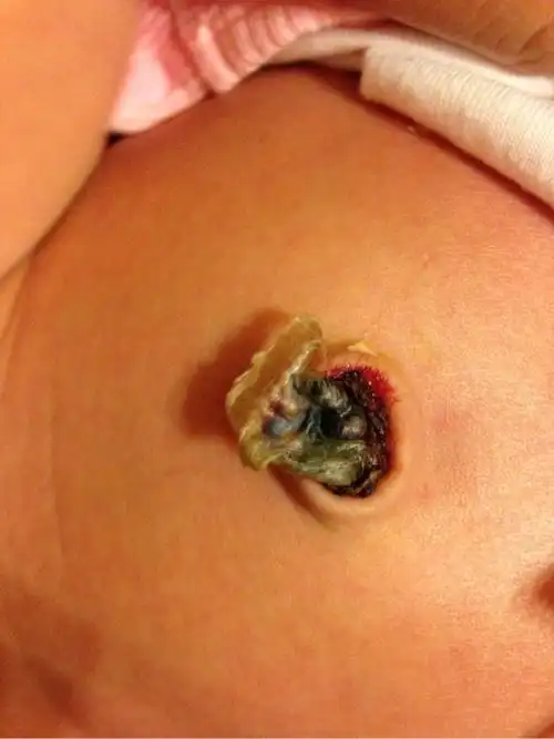 急问10天新生儿 肚脐眼有点渗血要紧吗照片