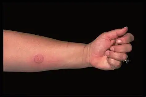 三,结核菌素试验反应与卡痕的关系有卡痕者阳性率明显高于无卡痕者.