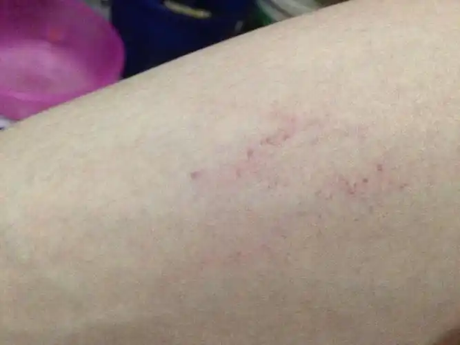 男,今天起床,发现大腿有几处长着血点,一点一点的,一片红红的,怎么