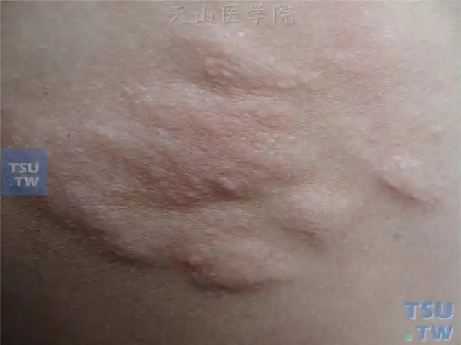 结节性硬化症(tuberous sclerosis)症状表现 - 皮肤病学 - 天山医学院