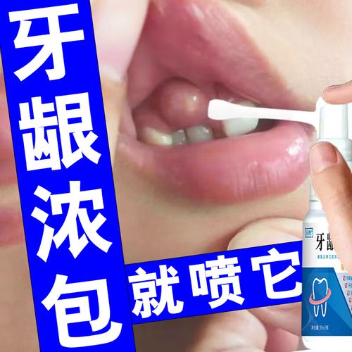 【官方】牙龈脓肿牙龈肿包牙根瘘管囊肿长脓包鼓包反复牙齿根尖周炎