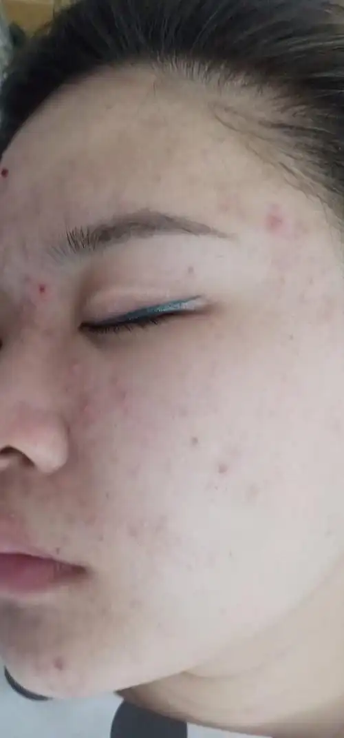 谢煌的聚合型痤疮 皮脂膜轻度受损 经过7个月的时间改善效果