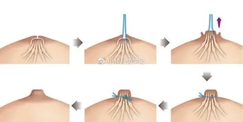 进行乳头凹陷矫正手术有什么好处和风险