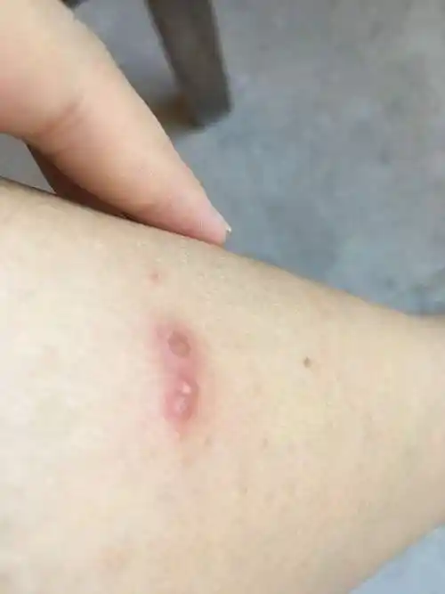 被虫子咬了怎么办 被虫子咬了肿了一大块怎么办