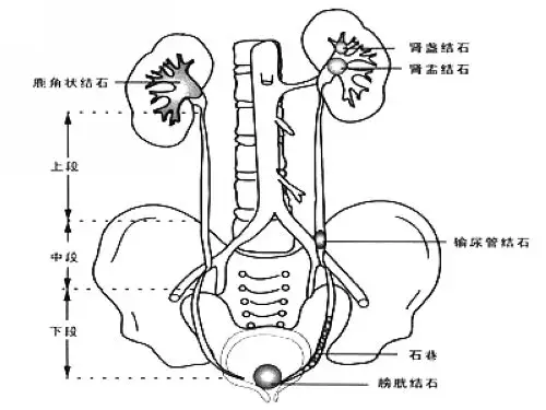 生活指南:肾结石自然排出法