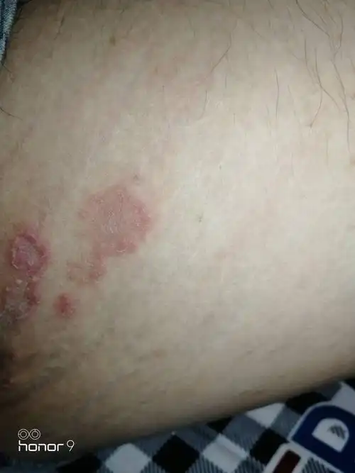 大腿内测这什么病啊 怎么办啊起红斑 摸起来好像皮掉了一样 平时不