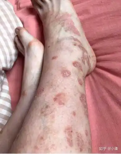 牛皮癣好了以后怎么能防止复发?