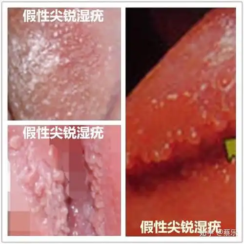 淘宝上卖的祛假性湿疣的药水管用吗,可以尝试吗?