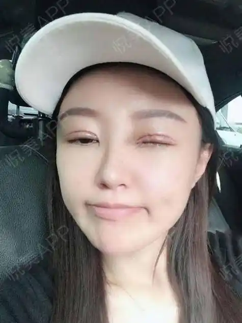 全切双眼皮术后7天_眼综合术后7天_双眼皮术后7天_眼部术后7天_兔兔