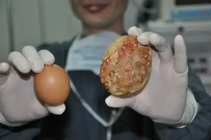 一日两瓶啤酒竟"喝"出肾结石